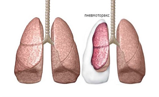 Пневмоторакс у детей - симптомы и лечение