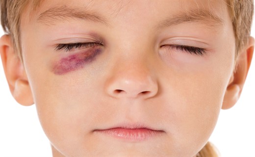 Лечение при травме глаза у ребенка thumbnail