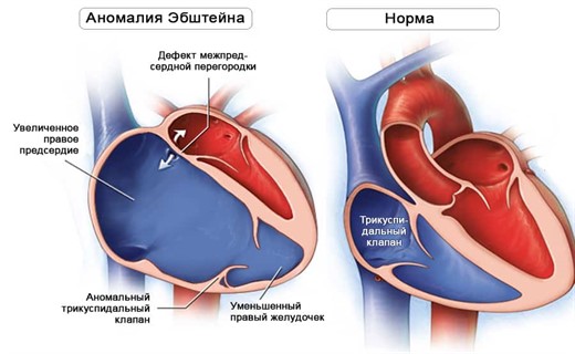 Диагностика порока сердца у детей
