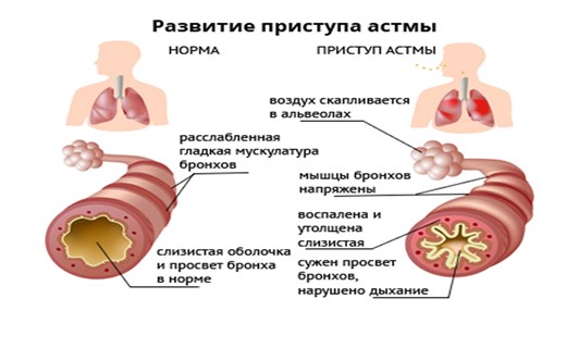 Дети больные астмой