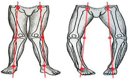 Симптомы рахита у детей