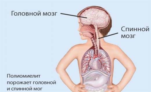 Клиническая картина полиомиелита у детей