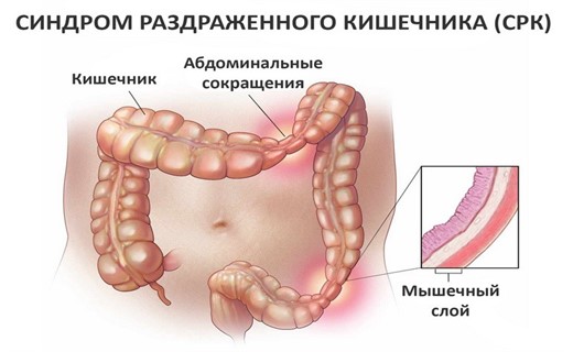 Синдром раздраженной толстой кишки