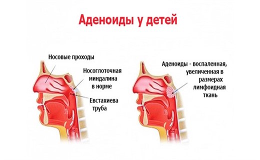 Где находятся аденоиды у ребенка картинка