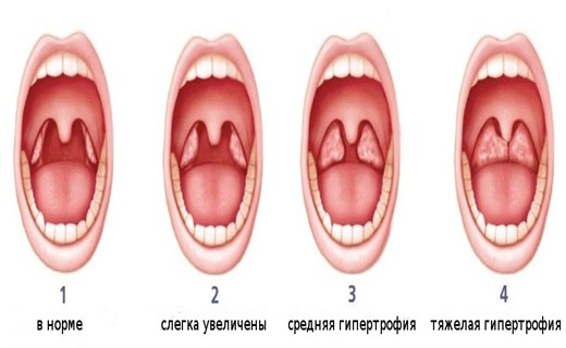 Фото Горла Ребенка Норма
