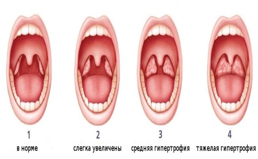 Операция на аденоиды