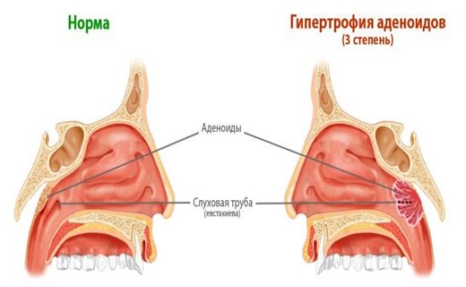 Аденоиды в носу