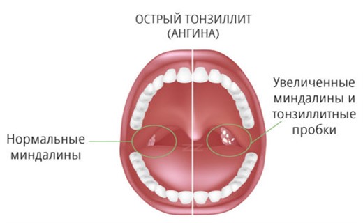 Фото острого тонзиллита