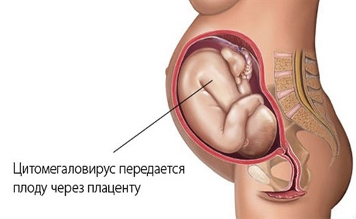 Врожденная цитомегаловирусная инфекция