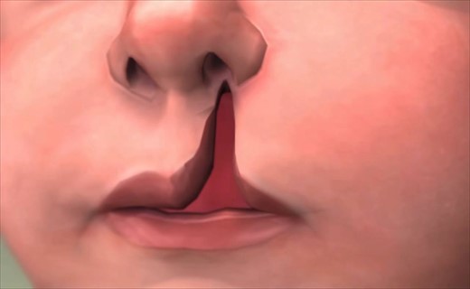 Врожденная заячья губа