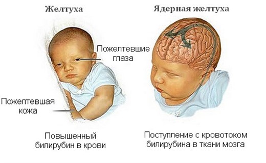 Фото ядерной желтухи у новорожденных