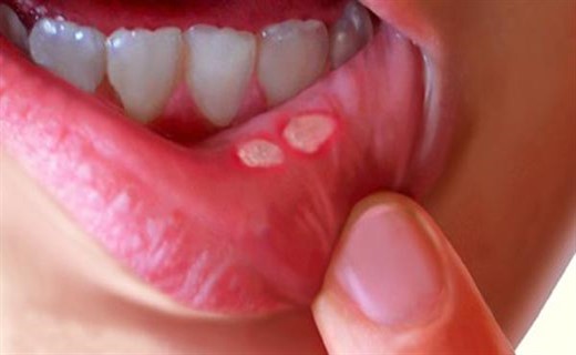Фото заболевания полости рта у детей