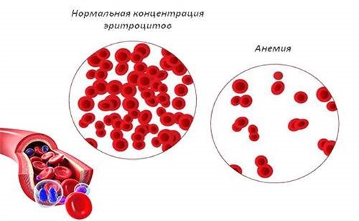 Анемия железа